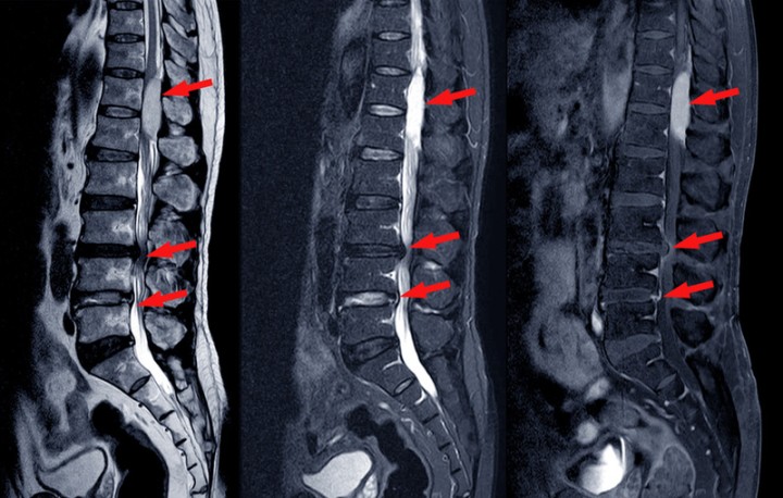 Veterans & Spinal Stenosis Disability Rating 888.878.9350